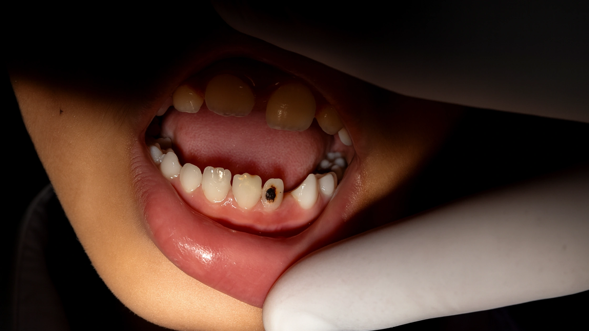 Jagged teeth
